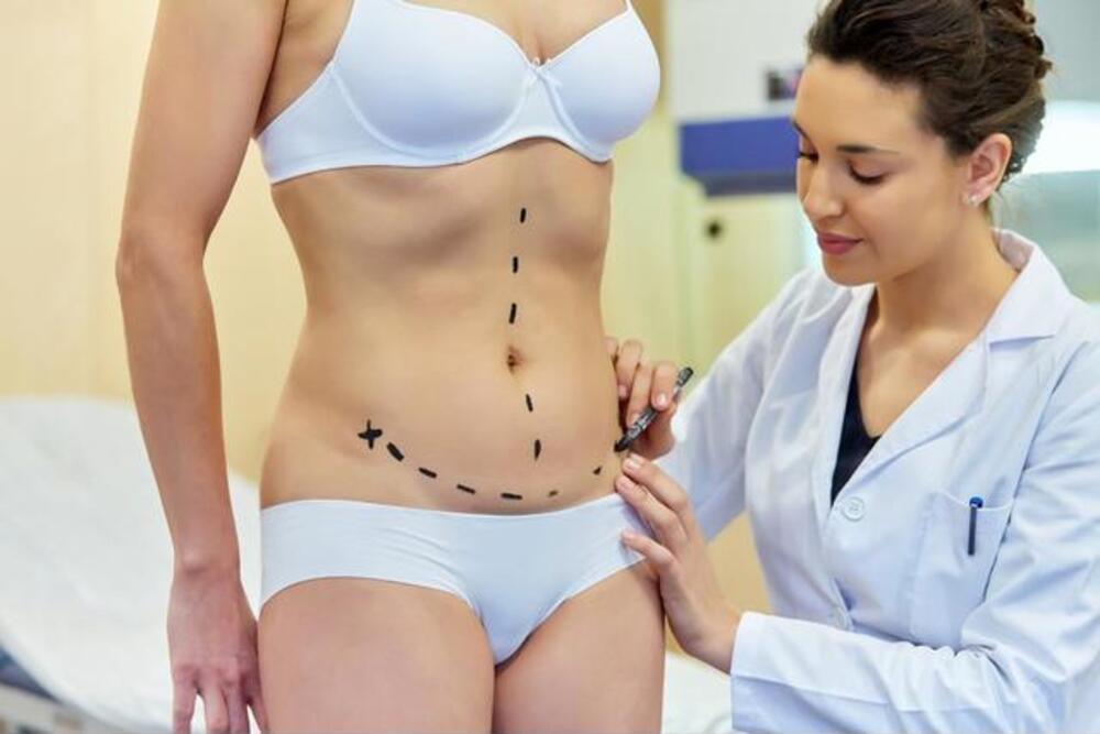 How to Prepare for your Tummy Tuck 